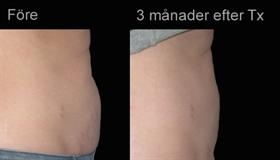 Mage (behandlingsresultat 3 månader) Mage (behandlingsresultat 3 månader)